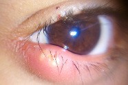 Comment Soigner Les Yeux Rouge Qui Brûlent?