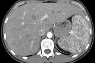 Comment Soigner Une Candidose Digestive?