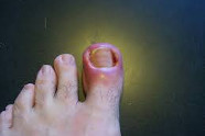 Comment Soigner L'ongle Incarné?